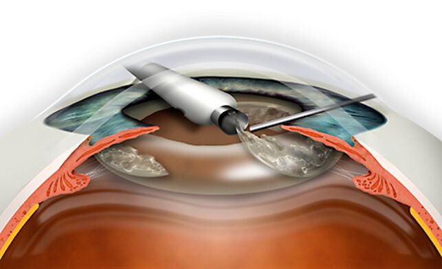 Refractive lens replacement is performed via MICRONADLE, which excludes blood loss