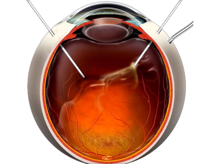 Vitrectomy - Procedure shown to people when the retiner peeling